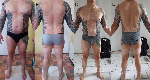 Pannello di immagini dell'uomo dalla vita in giù, che indossa biancheria intima, per mostrare macchie di pelle schiarita su tutto il corpo.