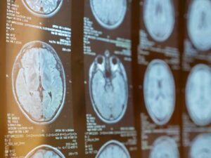 Una foto che mostra più scansioni MRI del cervello di qualcuno disposte a griglia.