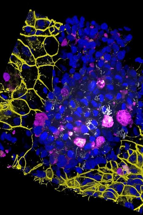 polmone su chip infettato da batteri della tubercolosi