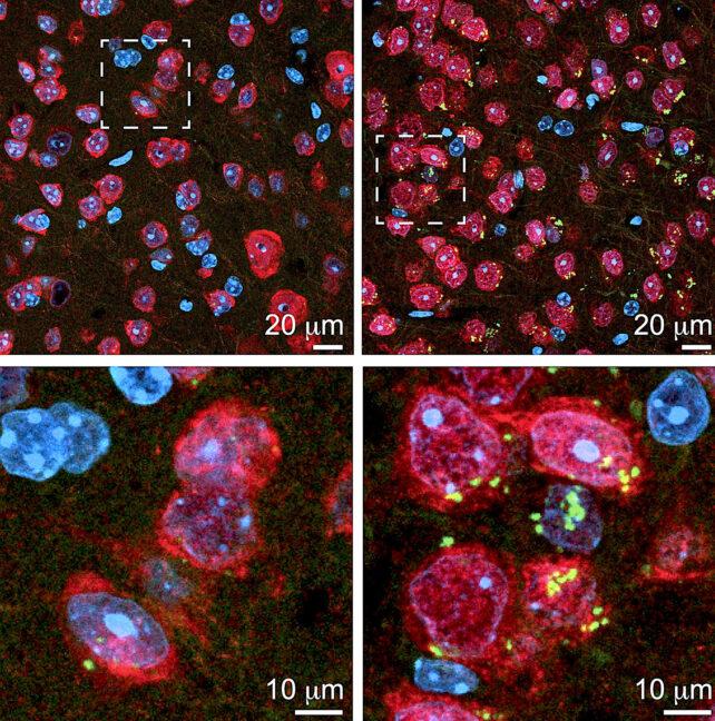 I ricercatori rivelano nuovi legami tra i sistemi di gestione dei rifiuti del cervello e la neurodegenerazione