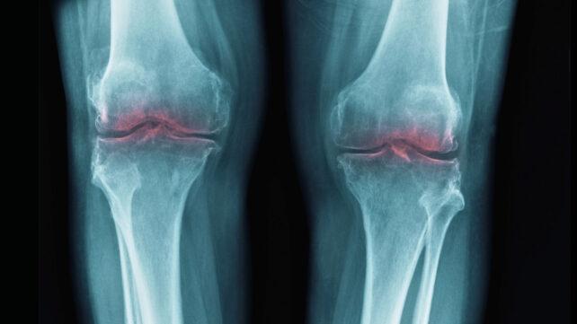 Ginocchia che mostrano infiammazione alla radiografia