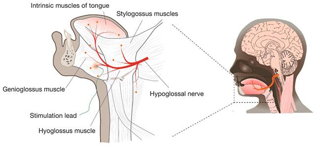 Stimolazione del nervo ipoglosso