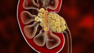 Scoperta sorprendente all'interno dei calcoli renali suggerisce che ci siamo sbagliati su come si formano