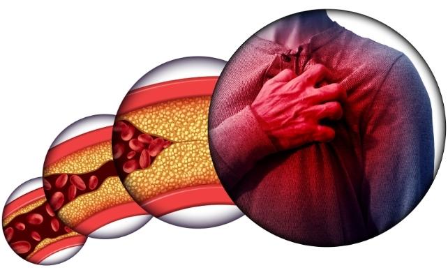 diagramma di arterie bloccate