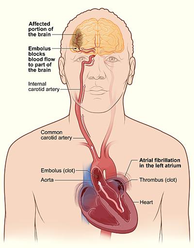 L'illustrazione mostra come un ictus possa verificarsi durante la fibrillazione atriale. Un coagulo di sangue (trombo) può formarsi nell'atrio sinistro del cuore. Se un pezzo del coagulo si stacca e viaggia verso un'arteria nel cervello, può bloccare il flusso sanguigno attraverso l'arteria. La mancanza di flusso sanguigno nella porzione del cervello alimentata dall'arteria causa un ictus.