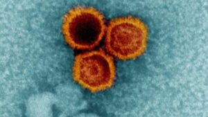 Gli scienziati scoprono nuove prove che un virus comune aiuta a scatenare la sclerosi multipla
