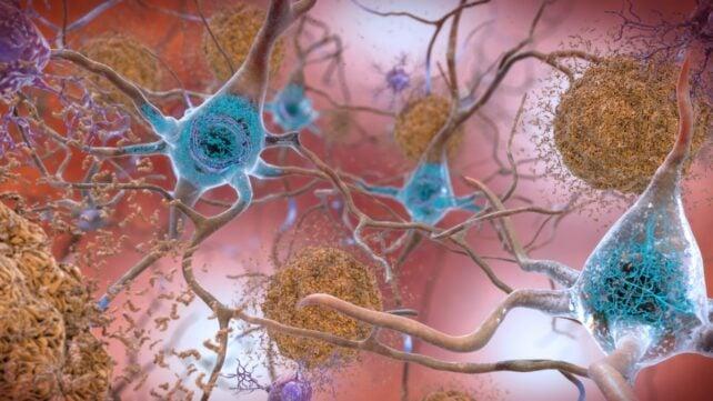 illustrazione delle placche di beta-amiloide nella malattia di Alzheimer