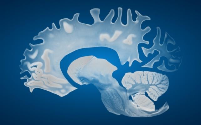 cervello blu con demenza