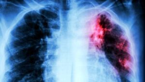 radiografia con evidenziazione rossa