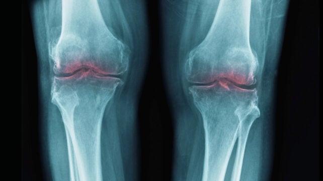 Ginocchia che mostrano infiammazione alla radiografia