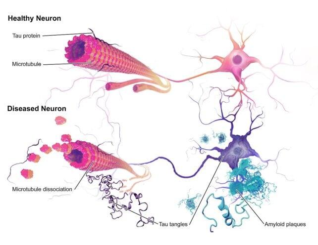 Una Competizione Tra Proteine Cerebrali Essenziali Può Guidare La Malattia Di Alzheimer, Suggerisce Una Nuova Ricerca