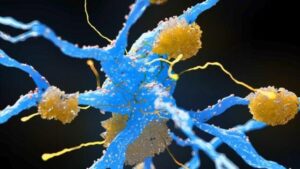Illustrazione delle placche amiloidi che si accumulano attorno ai neuroni blu, rappresentando i depositi proteici associati alla malattia di Alzheimer