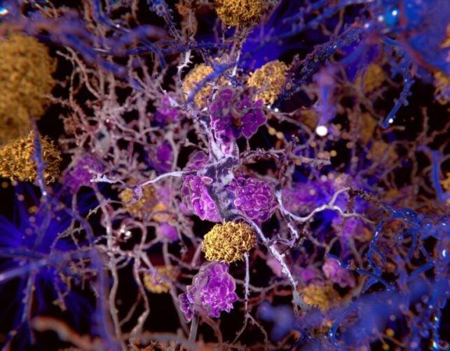 Illustrazione 3D di grumi gialli tra cellule e molecole blu e viola