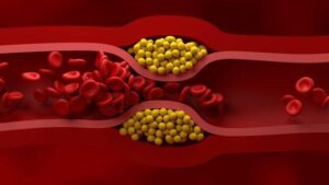 Vaso parzialmente bloccato in un alto livello di LDL (colesterolo cattivo) lipoproteina