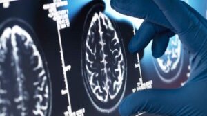 Diapositiva di scansione cerebrale