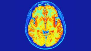 Sezione MRI assiale di un cervello umano