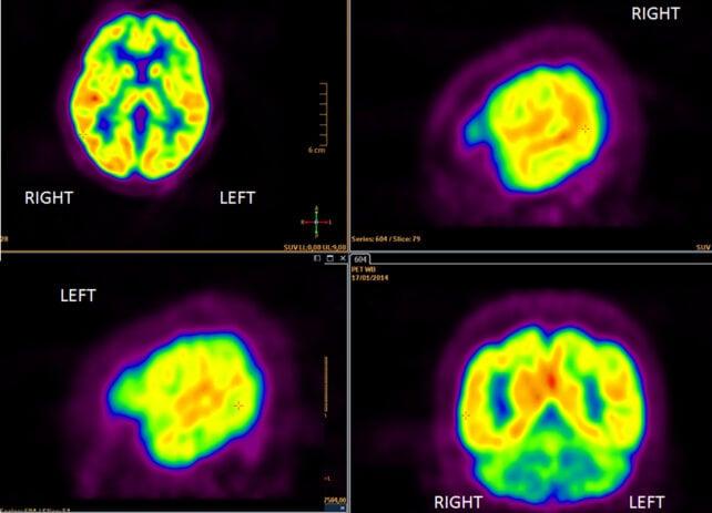 Nuovo test del sangue può prevedere la progressione dell'Alzheimer decenni in anticipo