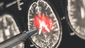 Cervello infiammato