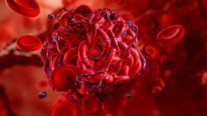 illustrazione del coagulo di sangue