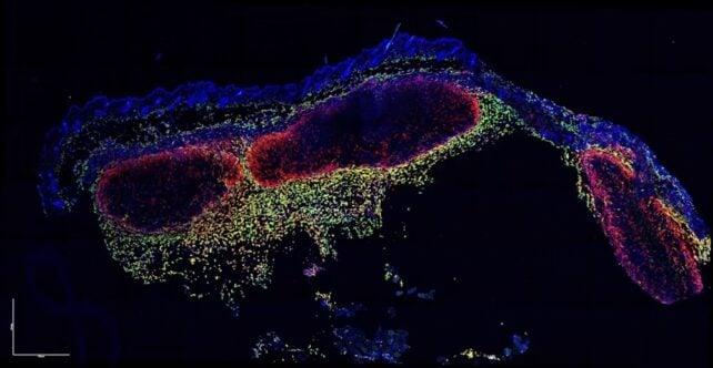 Guarda: cellule immunitarie catturate in video mentre mangiano cellule di cancro della pelle vive