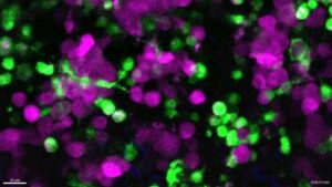Guarda: cellule immunitarie catturate in video mentre mangiano cellule di cancro della pelle vive