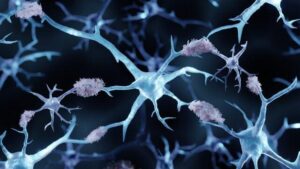 Illustrazione 3D che mostra le placche amiloidi nella malattia di Alzheimer