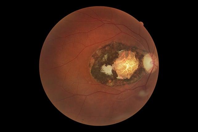 Lesione maculare (cicatrice) dovuta a toxoplasmosi congenita