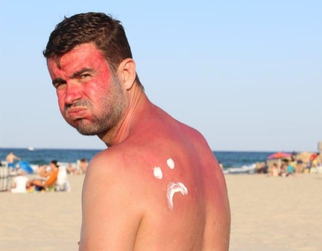 Un uomo scottato dal sole su una spiaggia, che guarda oltre la spalla