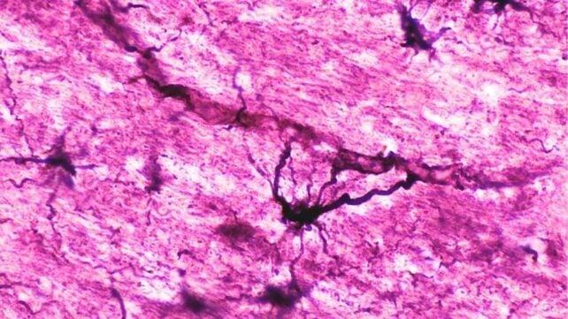 Neuromielite Ottica: Nuove Strategie con Trapianto di Cellule Staminali