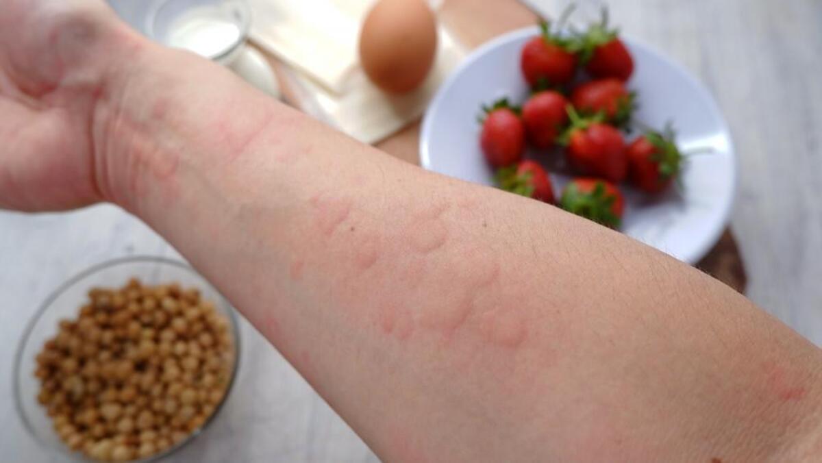Dopo un trapianto sviluppa la stessa allergia del donatore