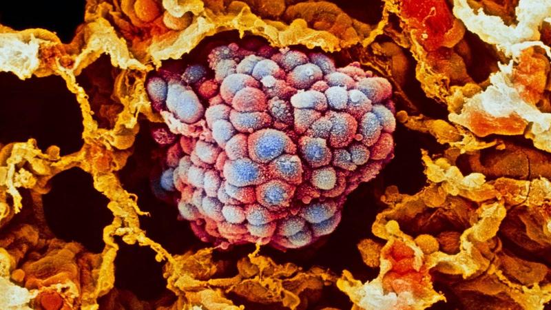 Una pillola antiparassitaria economica potrebbe aiutare a sconfiggere il cancro ai polmoni resistente ai farmaci