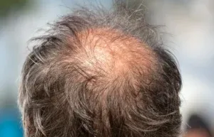 Una nuova pillola contro la caduta dei capelli si avvia all’approvazione della FDA. Ha avuto effetti positivi su 500 uomini calvi