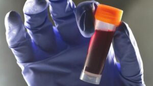 Un gruppo sanguigno sembra comportare un rischio maggiore di diabete di tipo 2