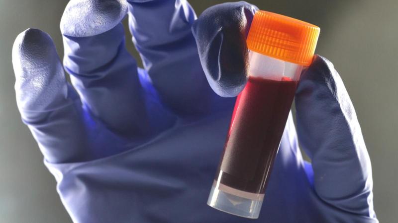 Un gruppo sanguigno sembra comportare un rischio maggiore di diabete di tipo 2