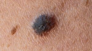 Primo vaccino antitumorale al mondo riduce del 42% il rischio di recidiva del melanoma o di morte in uno studio storico