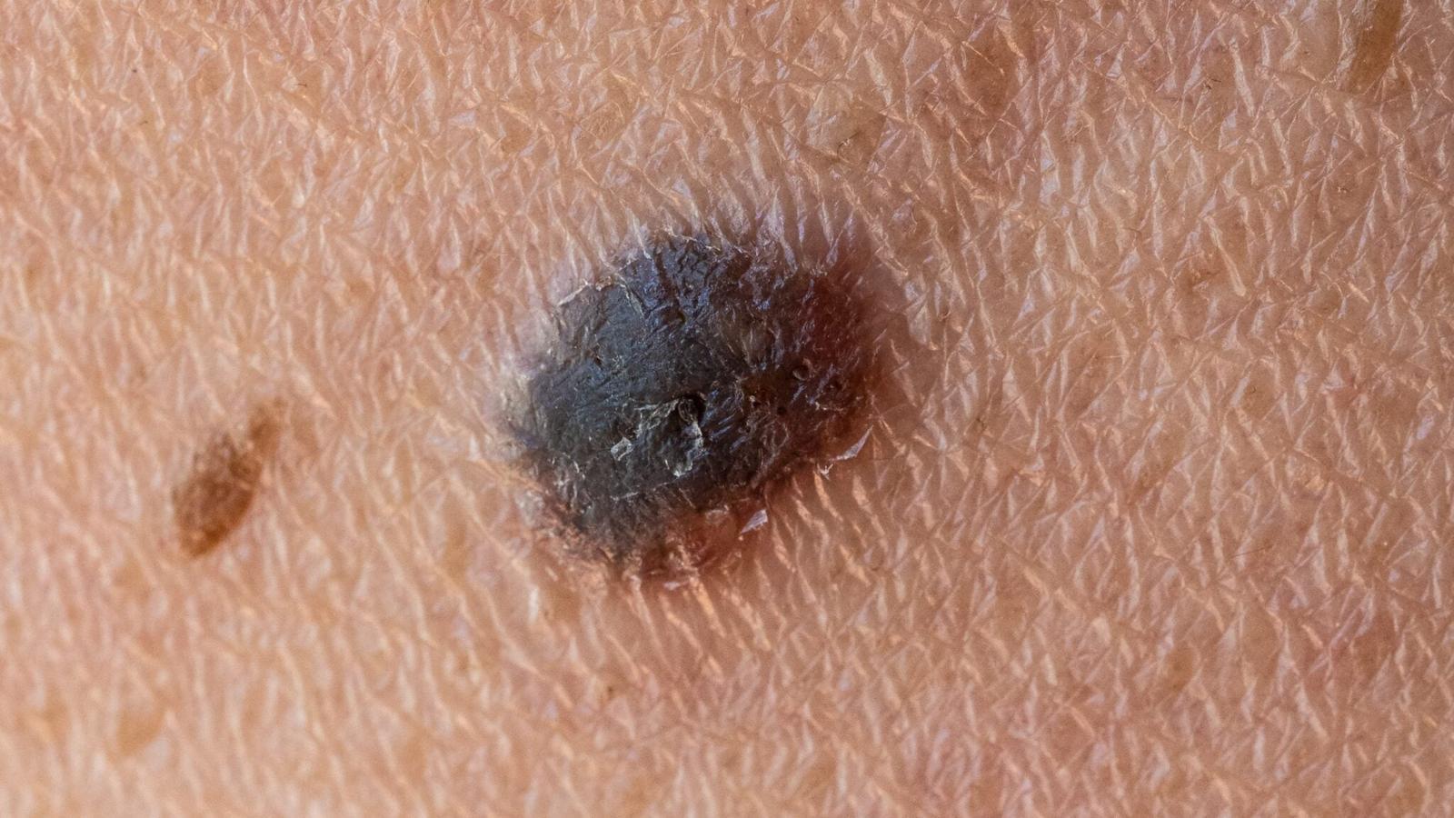 Primo vaccino antitumorale al mondo riduce del 42% il rischio di recidiva del melanoma o di morte in uno studio storico